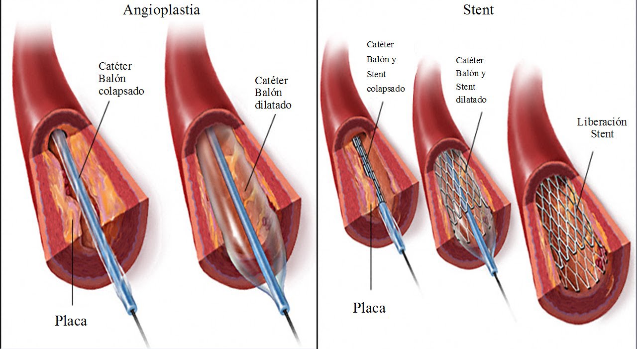 Операция ангиопластика. Баллонная ангиопластика коронарных артерий. Лазерная ангиопластика коронарных артерий. Баллонная ангиопластика при ИБС. Стентирование миокарда.